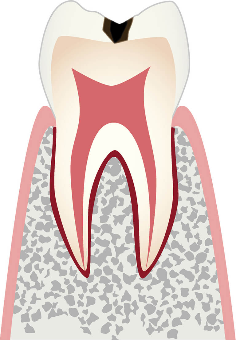 C1 エナメル質に小さな穴が空いたむし歯