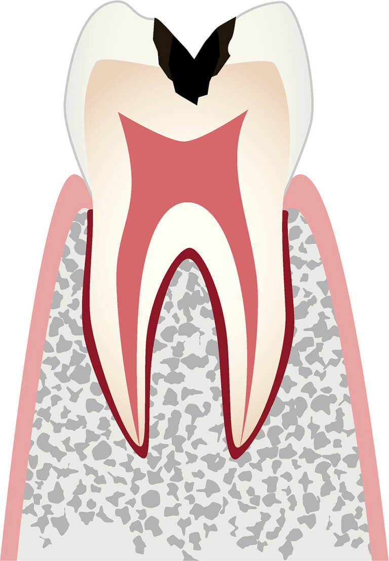 C2 歯の内部（象牙質）まで進行したむし歯